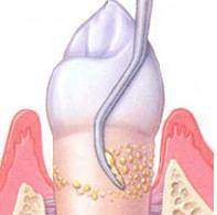 Raspallat Subgingival