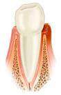Gingivitis