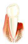 Periodontitis