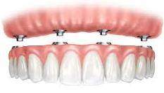Il·lustració d'una dentadura removible