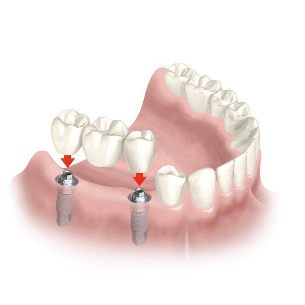 Preguntas frecuentes sobre implantes dentales