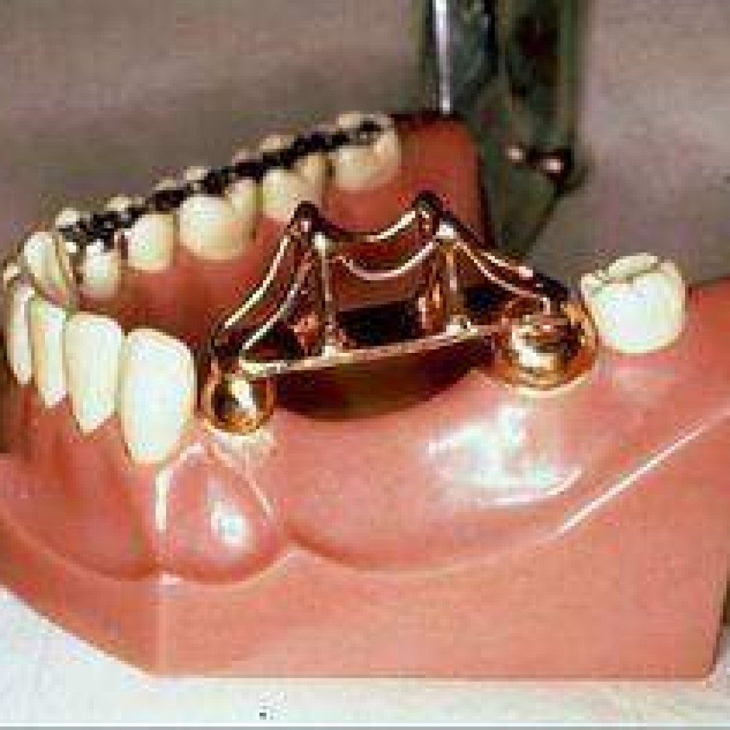 Desventajas de un puente fijo frente a un implante dental