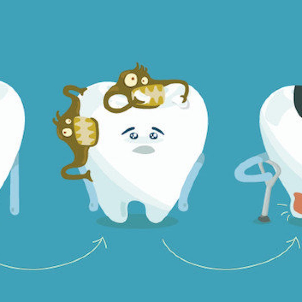 Preguntas frecuentes sobre cómo detectar una caries