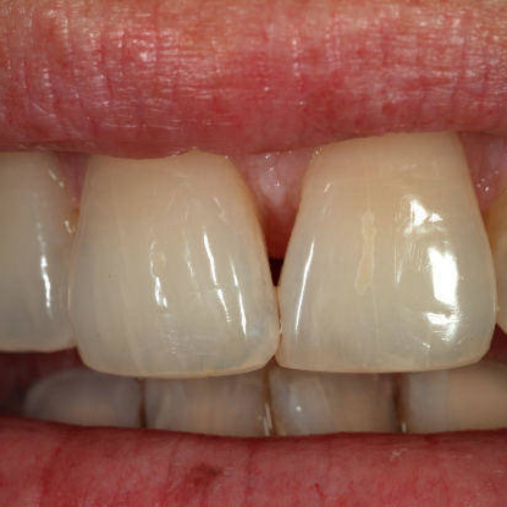 implantes-dentales-paletas