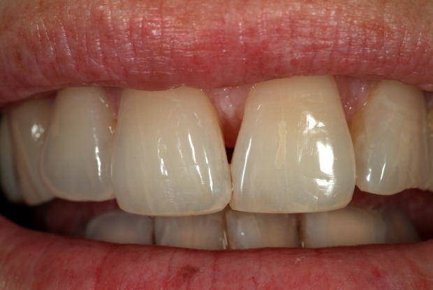 implantes-dentales-paletas
