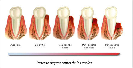 progreso enfermedades periodontales