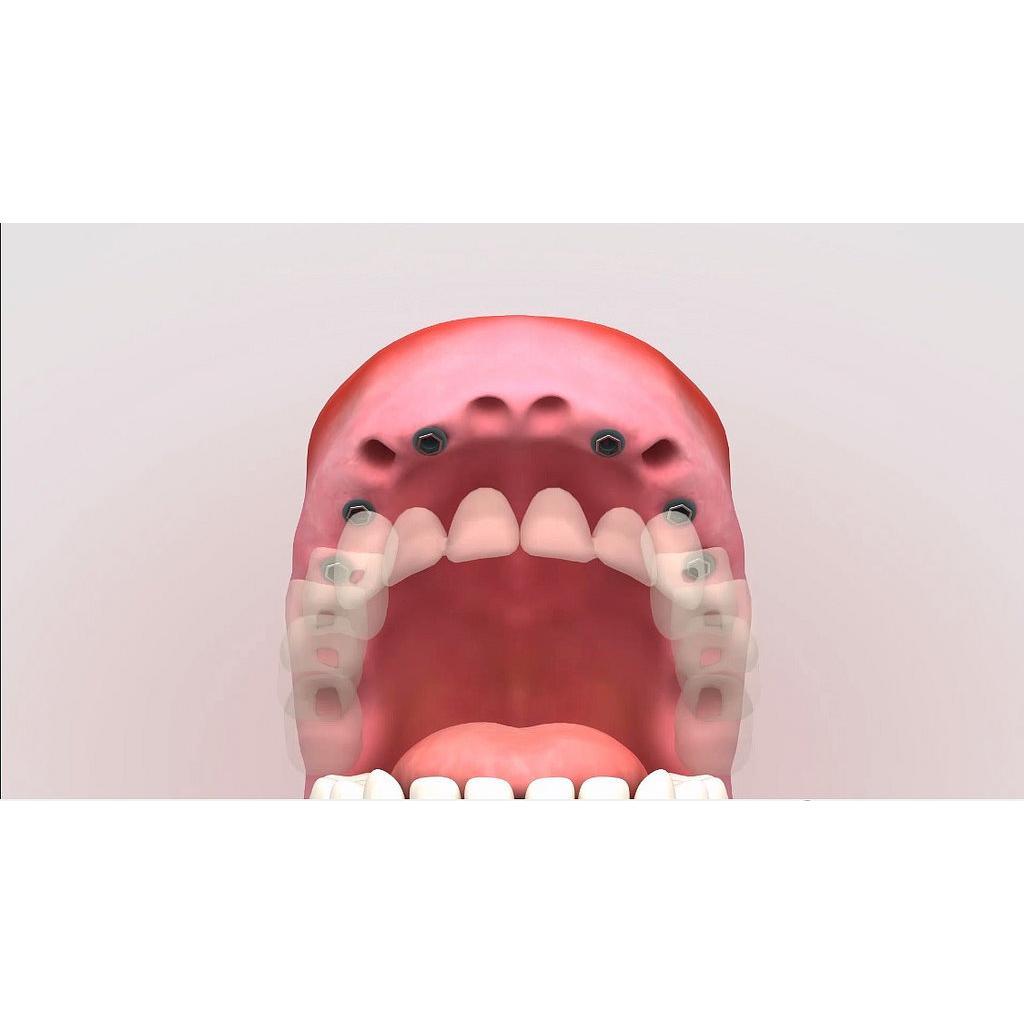 implantes dentales dentadura