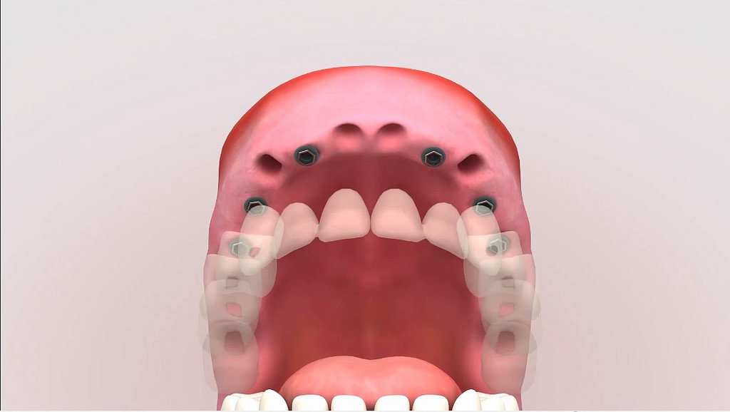 implantes dentales dentadura